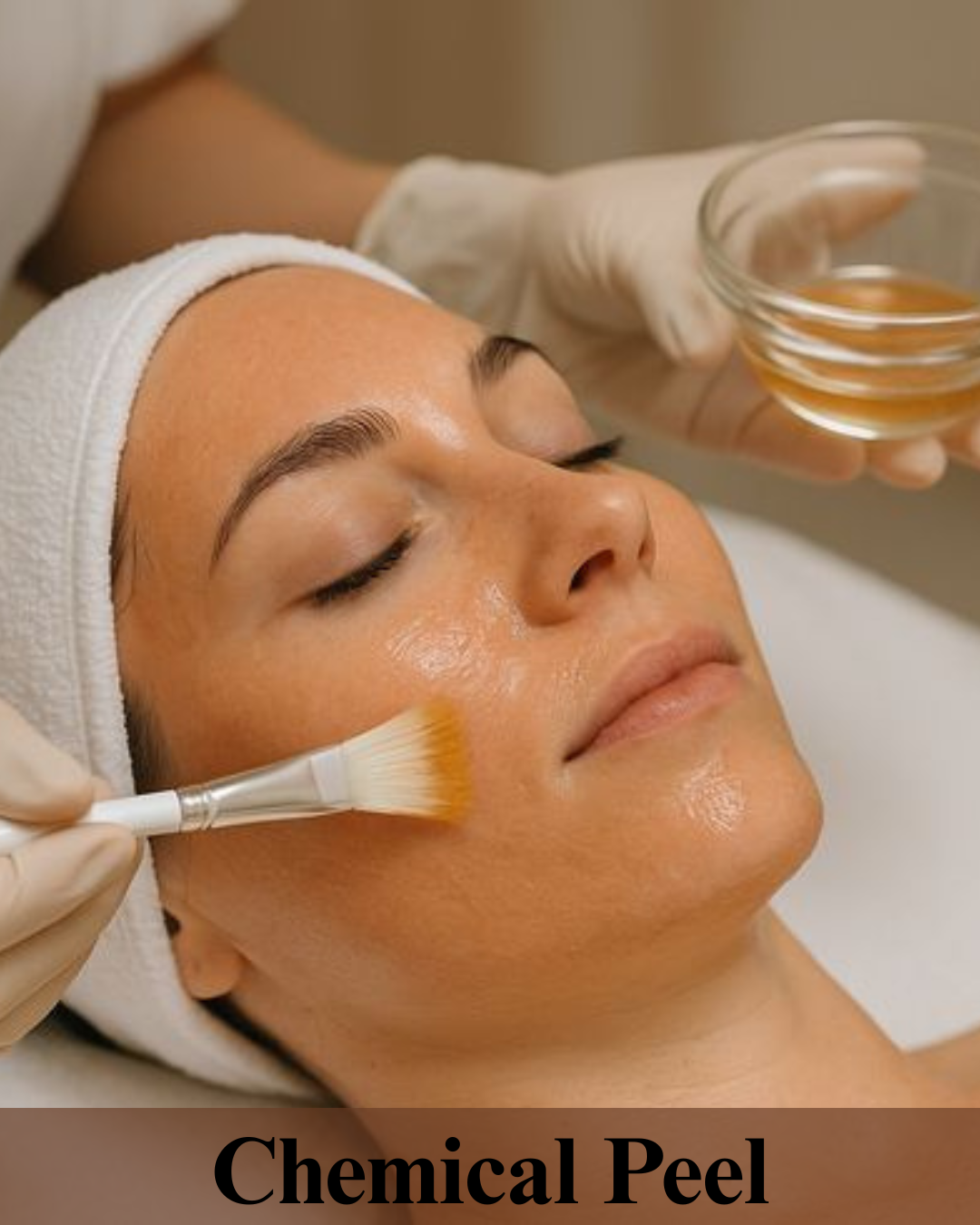 Chemical Peel 1